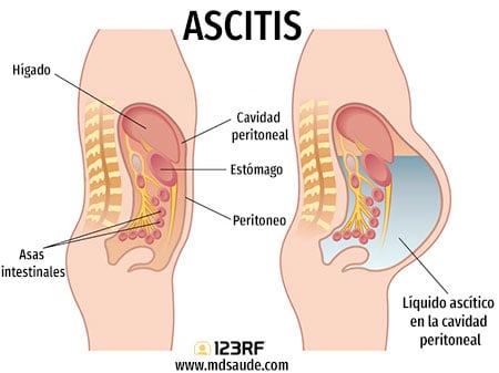 Ascitis: acumulación de líquido en el área que rodea los órganos en el abdomen.