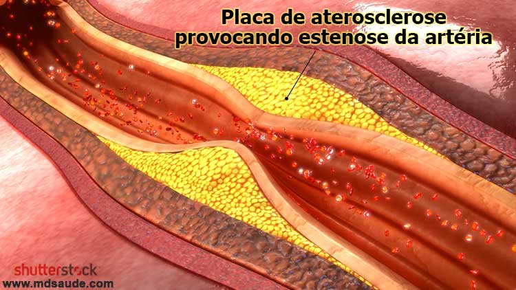 Placas de aterosclerose provocando estenose da carótida.