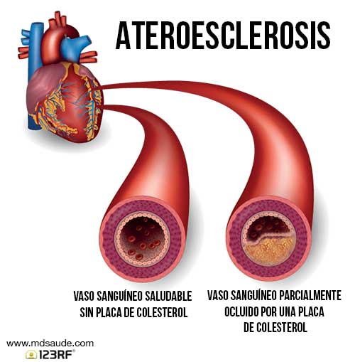 aterosclerosis