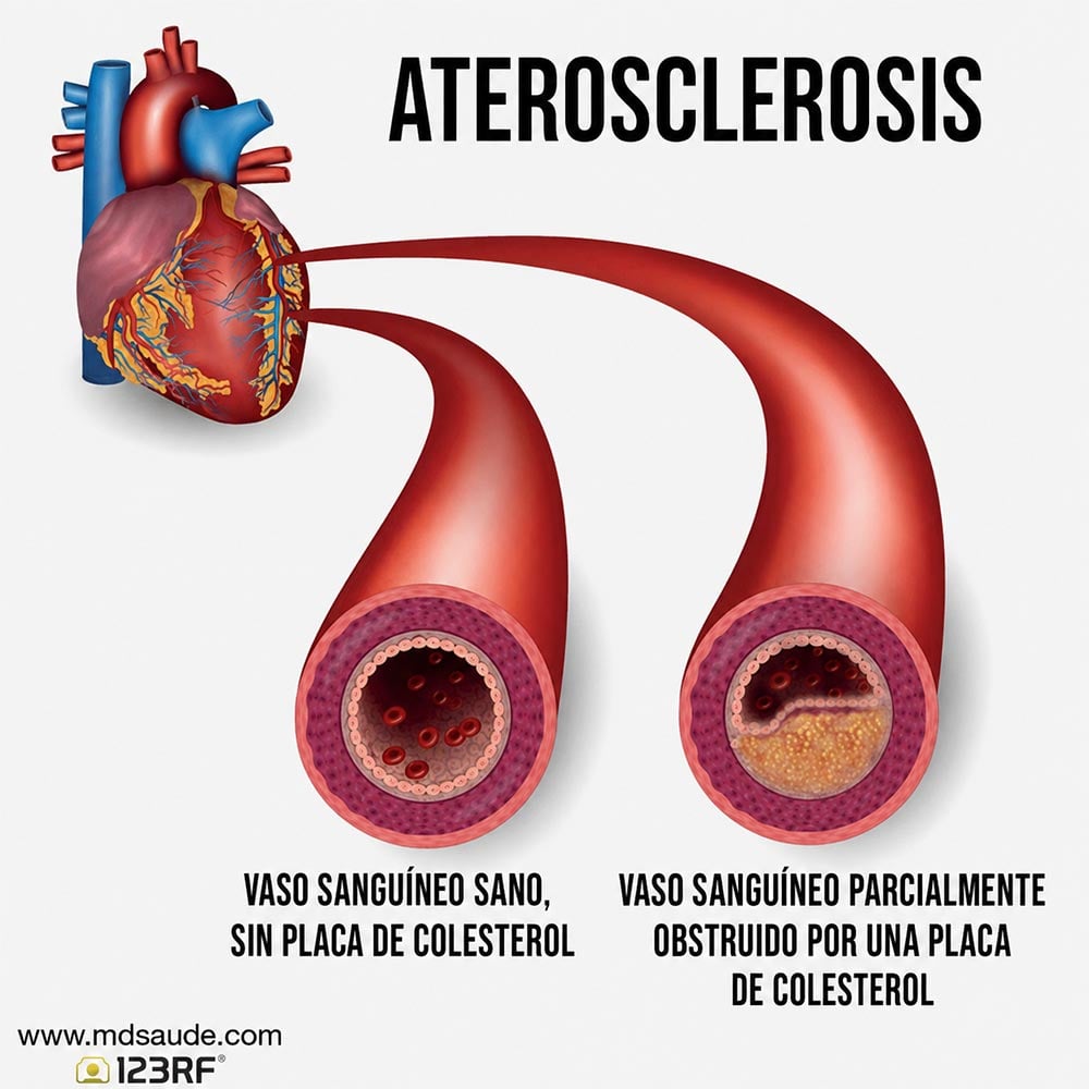 La aterosclerosis se caracteriza por la acumulación de placas de colesterol y otros elementos en las paredes internas de las arterias, lo que provoca su endurecimiento y estrechamiento y puede comprometer el flujo sanguíneo.