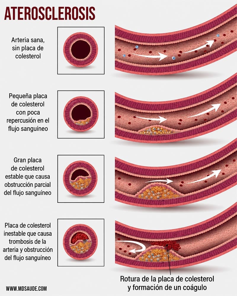 Cómo se produce un infarto de miocardio