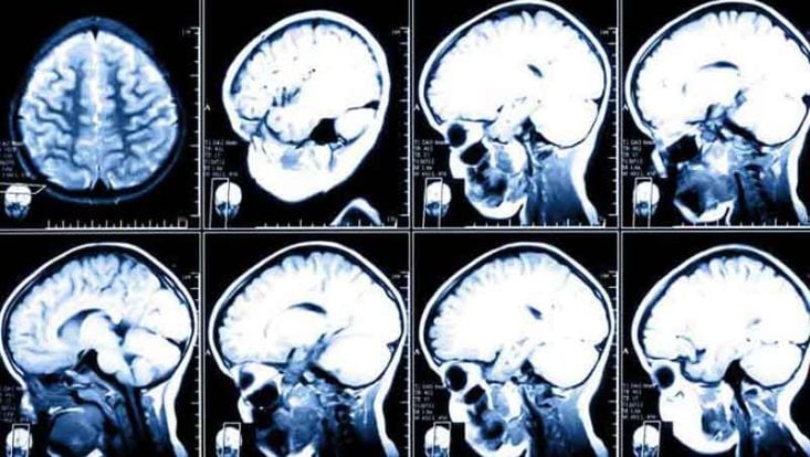 7 Síntomas del ACV - Accidente cerebrovascular