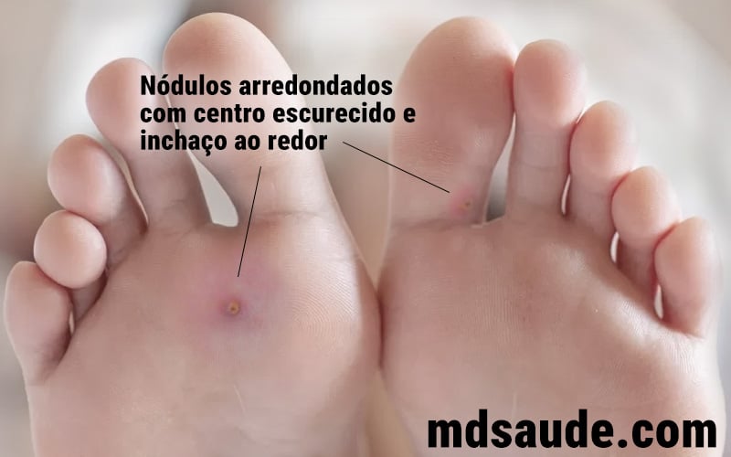 Foto de bicho-do-pé.