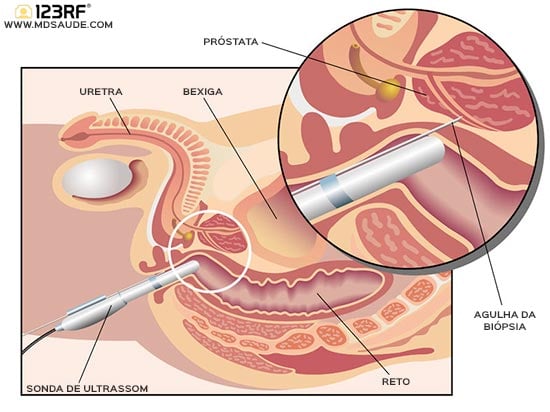 possiveis resultados de biopsia de prostata)