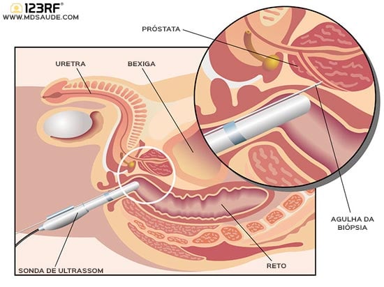 Biópsia da próstata