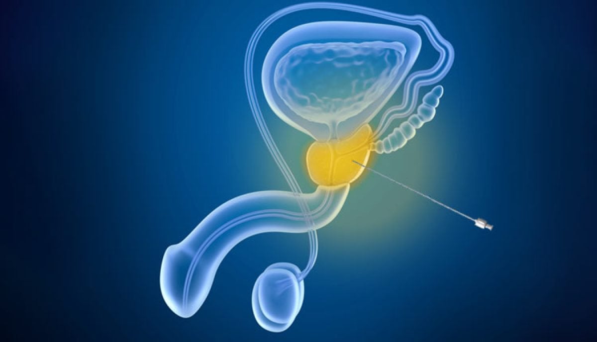 Biopsia De Prostata Por Ultrassom Transretal