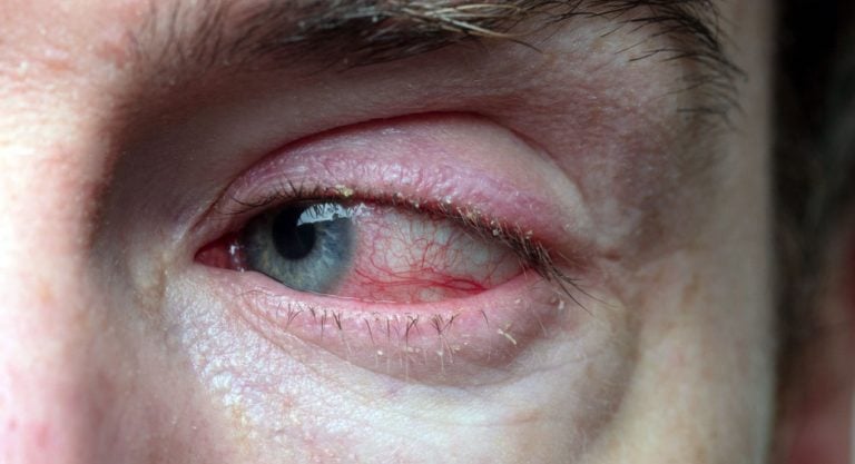 26 causas de olho vermelho e irritado (com fotos)