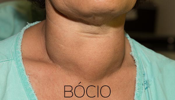 Bócio