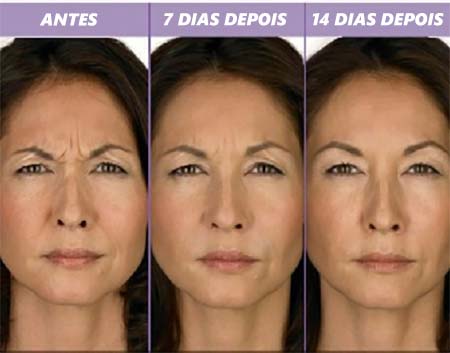 Botox antes e depois