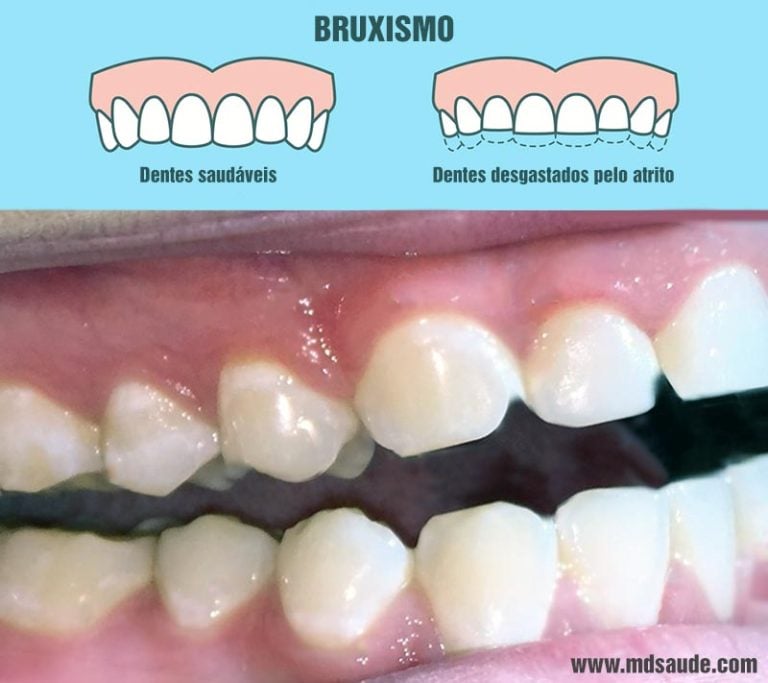 Bruxismo: o que é, sintomas, placas e outros tratamentos