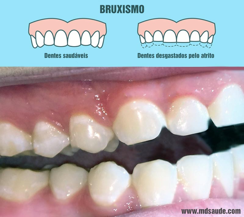 Bruxismo do sono - saiba como evitar as dores e desgastes dos dentes