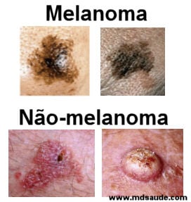 O sinal oculto do câncer de pulmão que pode ser visto nos dedos