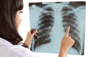 FATORES DE RISCO PARA O CÂNCER DE PULMÃO