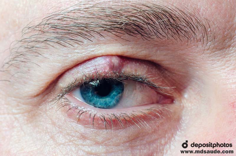Terçol no Olho: Causas, Sintomas, Autocuidados e Tratamento