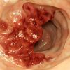 Cáncer de Colon y Recto – Síntomas, Causas y Tratamiento