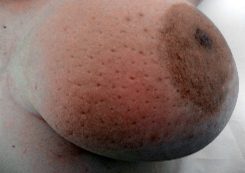 Cáncer de mama inflamatorio con la apariencia característica de peau d’orange.