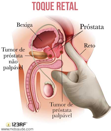 tumor na prostata benigno)