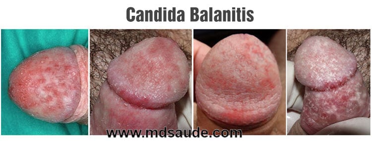 Candida Balanitis