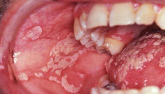 Candidiasis oral en el interior de la mejilla y en la lengua