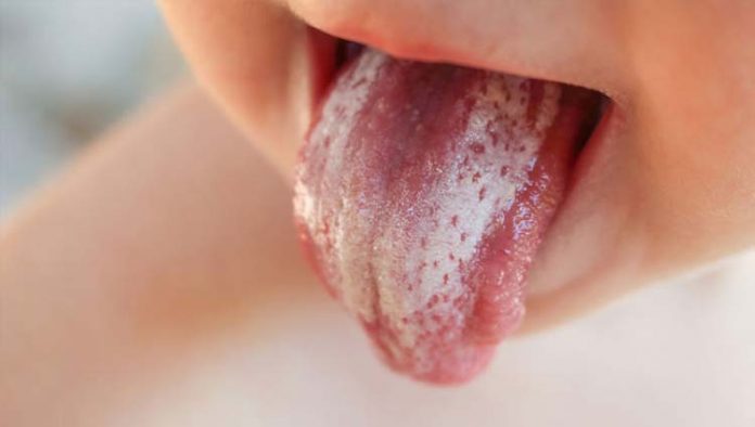 candidiase-oral Candidíase oral