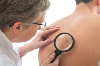CARCINOMA BASOCELULAR DE PELE – Causas, sintomas e tratamento