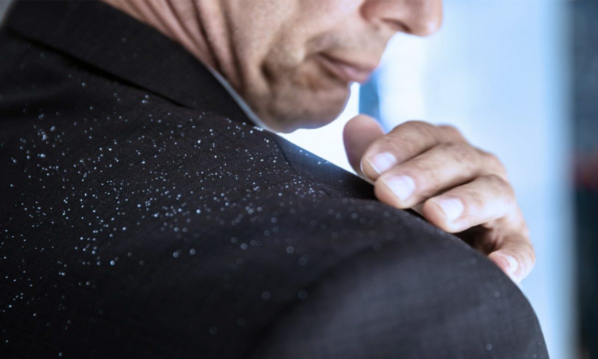 La Caspa Se Pega De Una Persona A Otra Caspa: causas, síntomas y tratamiento | MD.Saúde