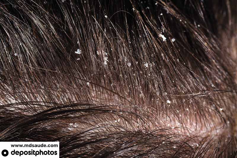 Caspa no cabelo