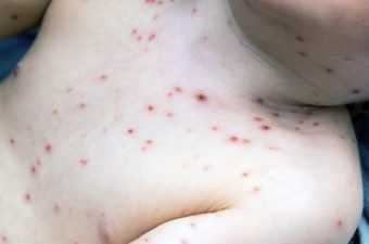 VARICELA – Síntomas, tratamiento y vacuna