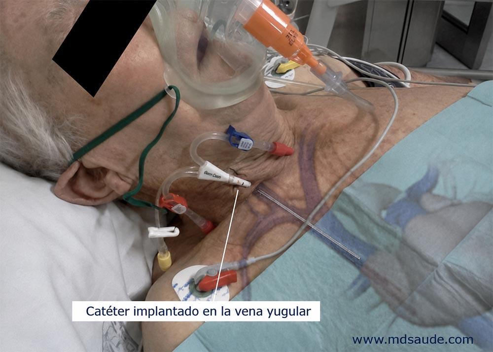 Catéter venoso en la vena yugular interna