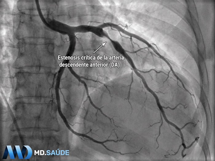 Coronariografía de las arterias coronarias izquierdas que muestra una estenosis crítica en el segmento proximal de la arteria descendente anterior (DA), señalada con una flecha blanca.