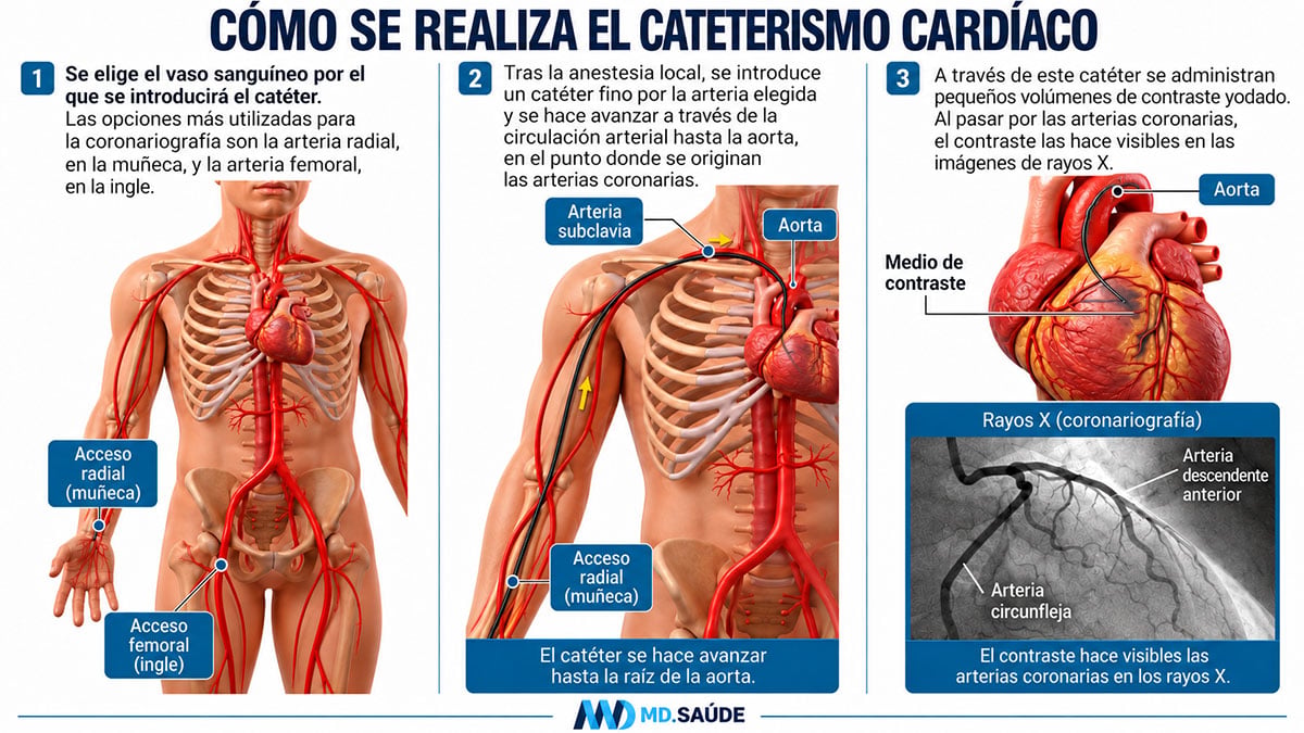 Infografía con las tres etapas del cateterismo cardíaco: elección del acceso por la arteria radial o femoral, avance del catéter hasta la raíz de la aorta e inyección de contraste yodado para visualizar las arterias coronarias mediante rayos X.