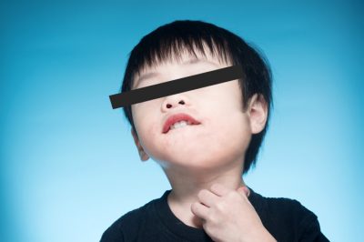 CAXUMBA – Transmissão, sintomas e tratamento