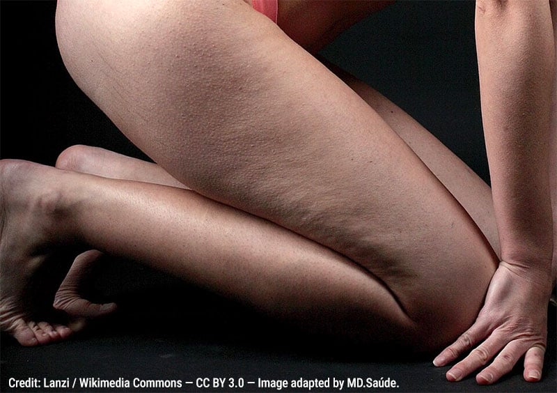 Celulite em mulher magra e que pratica atividade física regular