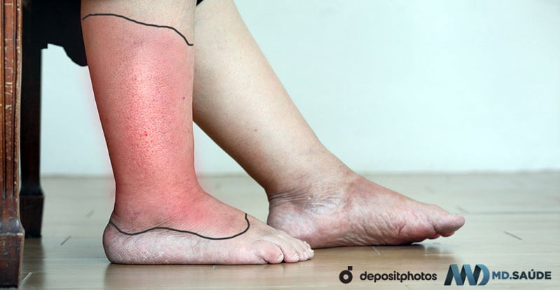 Celulitis en la pierna derecha: bordes de la lesión marcados con un marcador para evaluar la velocidad de expansión.