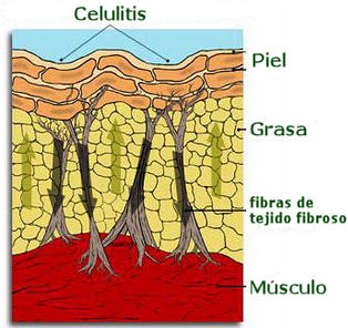 celulitis