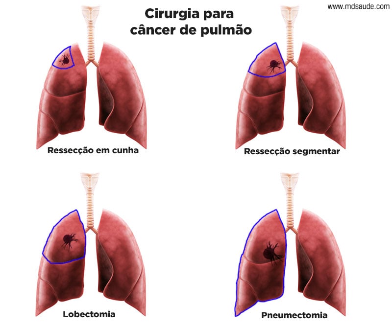 Opções de cirurgia para câncer do pulmão