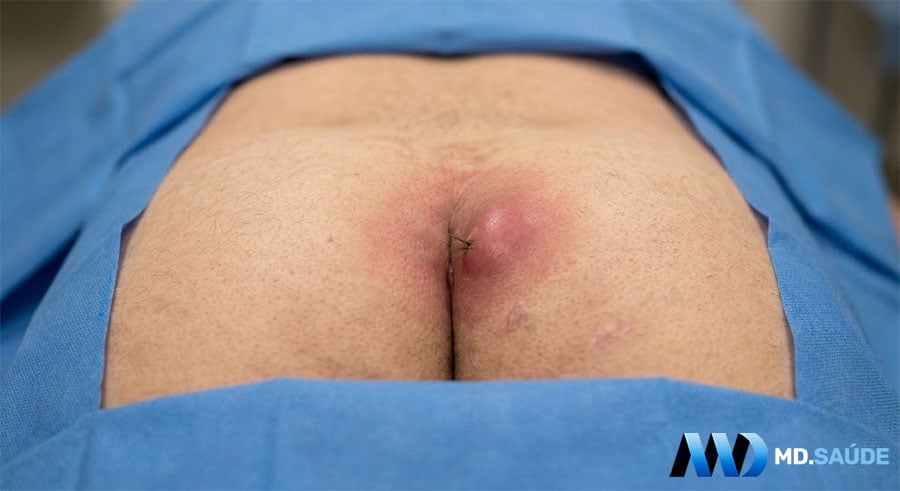 Cisto pilonidal infectado