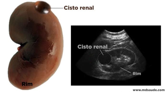 Cisto Renal Simples - O que é, Sintomas e Tratamento » MD.Saúde
