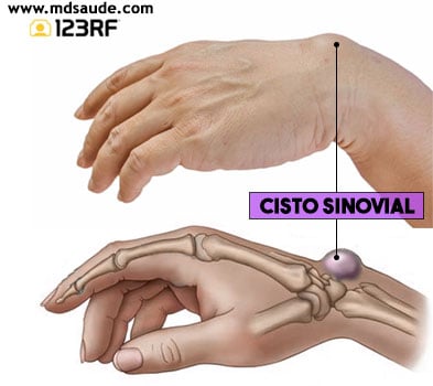 Cisto sinovial: o que é, sintomas, causas e tratamento - Tua Saúde