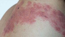 Shingles (Herpes Zoster): Causes, Symptoms, and Treatment