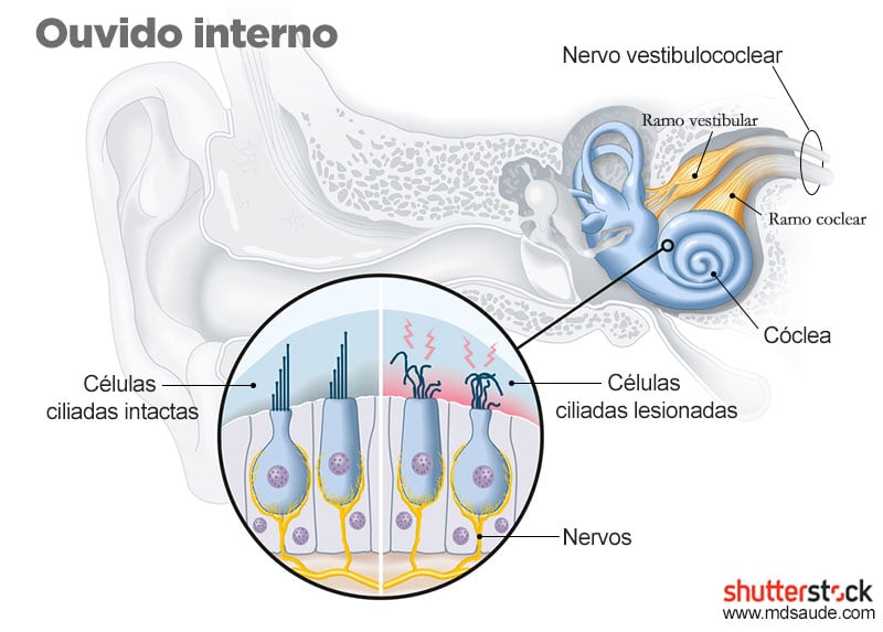 Ouvido interno - Lesão nas células ciliadas da cóclea
