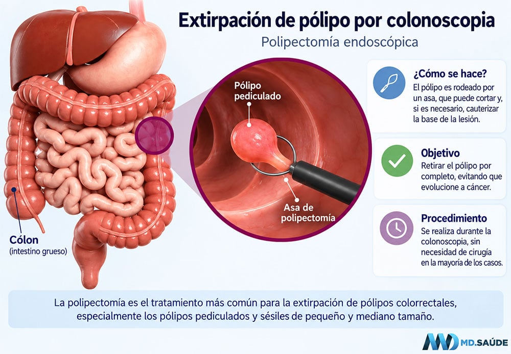 Polipectomía con asa