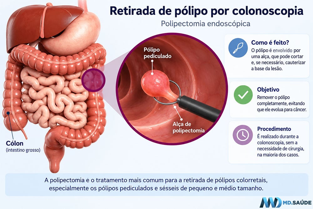 Polipectomia com alça