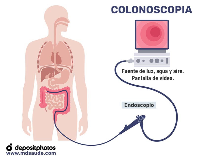 Colonoscopia
