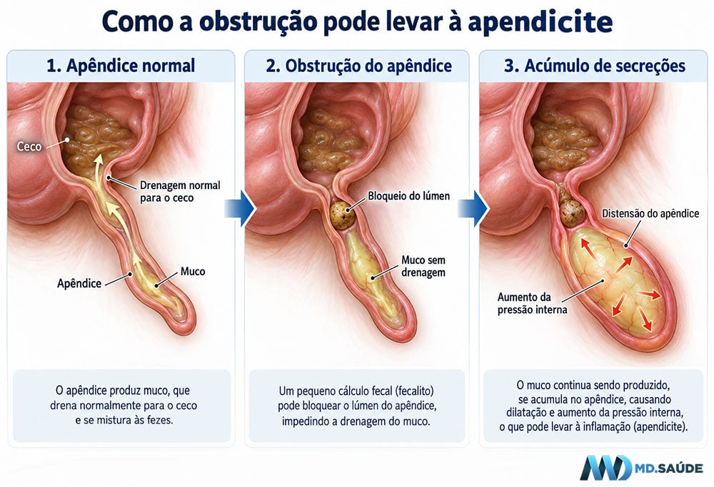 Distensão do apêndice por obstrução da drenagem de muco