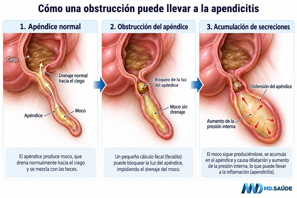 Distensión del apéndice por obstrucción del drenaje de moco
