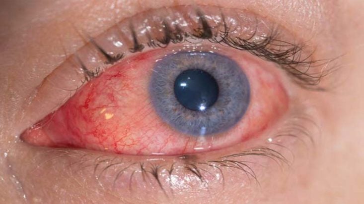 Conjuntivitis alérgica