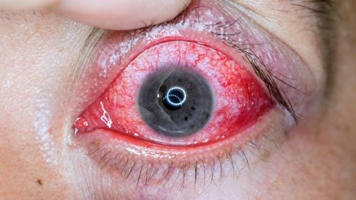 Acordou com o olho inchado, doendo levemente e com um nódulo vermelho?  Provavelmente isso que você tem é um hordéolo ou terçol, como popularmente  é, By VISIO - Clínica de Olhos