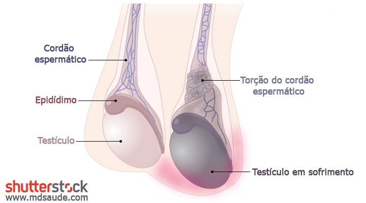 Espermatocele: o que é, sintomas, causas e tratamento - Tua Saúde