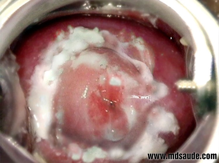 cottage cheese discharge: candidiasis